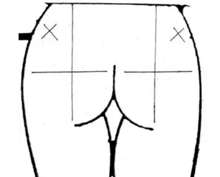 Glute Injection Site